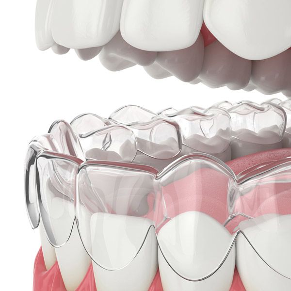Invisalign tray over teeth