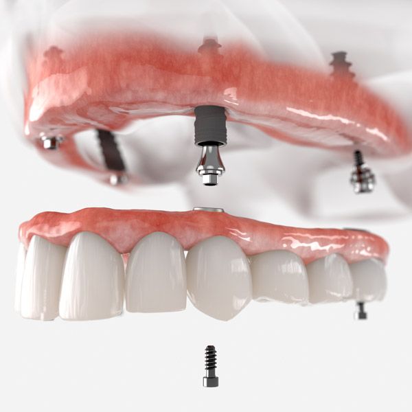 Implant denture