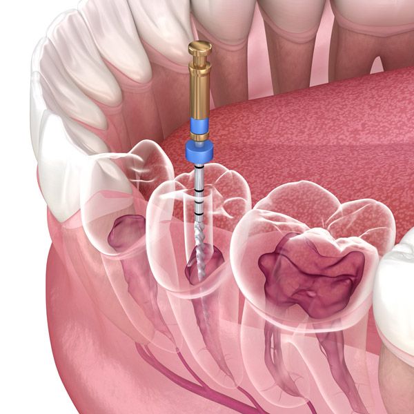 Illustration of tooth highlighting inner structures