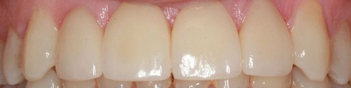 After veneers and crowns procedure