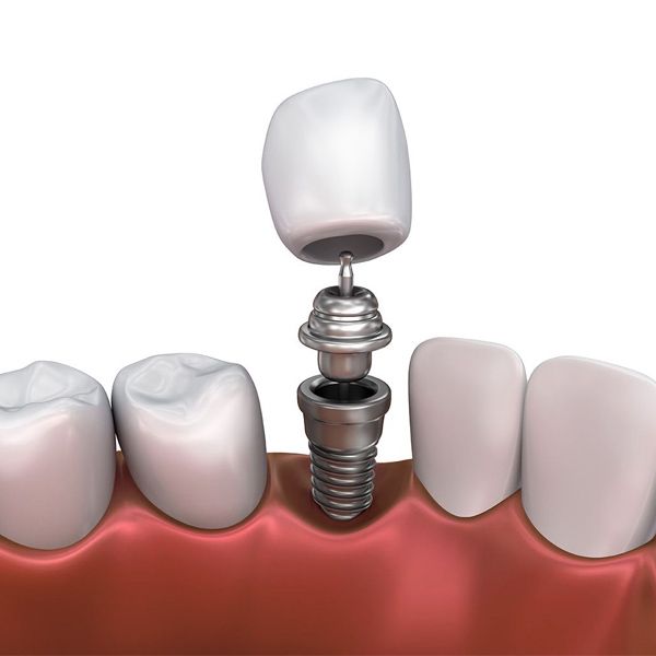 Implant-Supported Crown