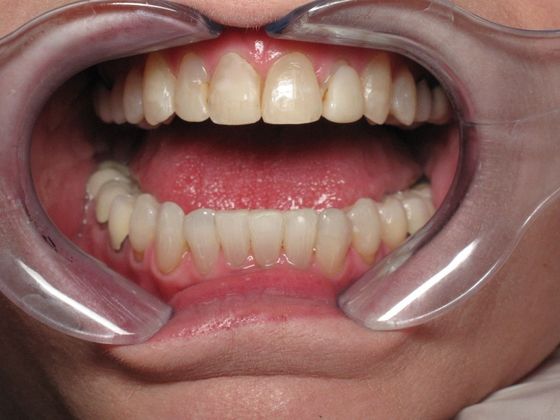 Discolored, uneven teeth