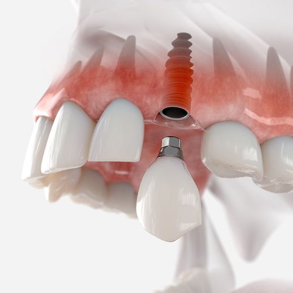 Dental implant