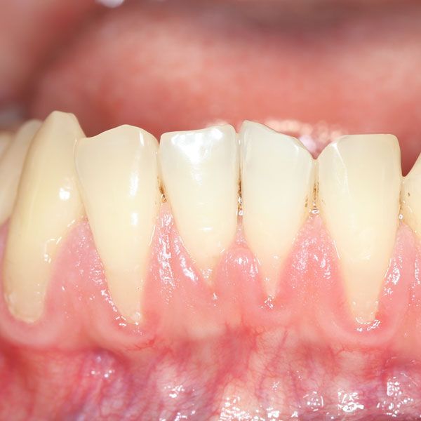 Receding Gums