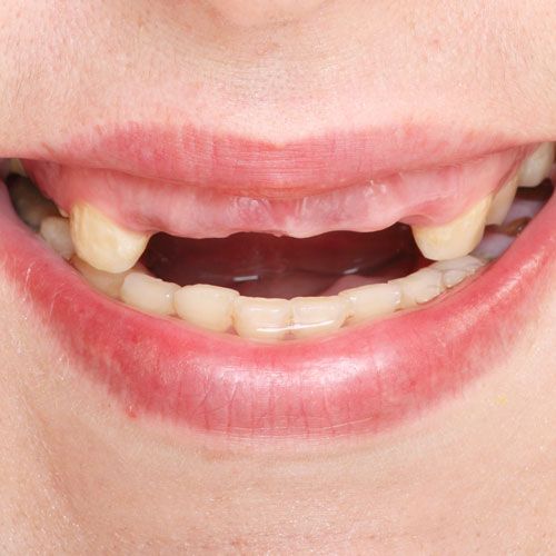 Missing teeth