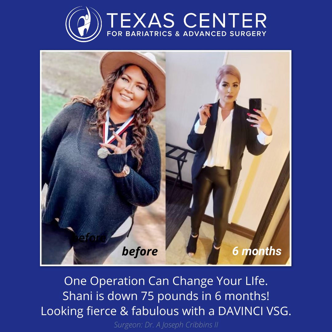 da vinci weight loss surgery patient before and after dallas tx