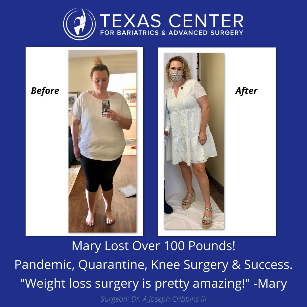 Weight Loss Surgery Texas Center for Bariatrics & Advanced Surgery
