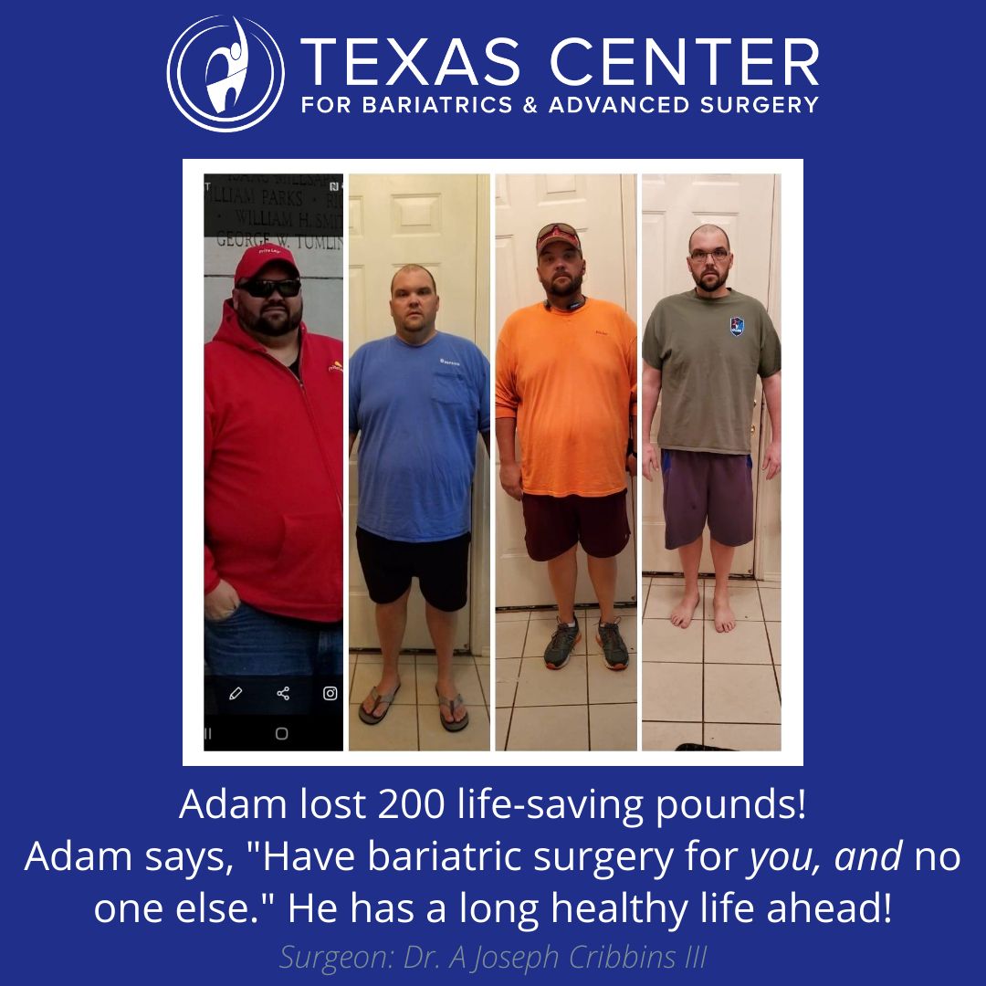 weight loss surgery transformation with da vinci xi and dr cribbins dallas tx