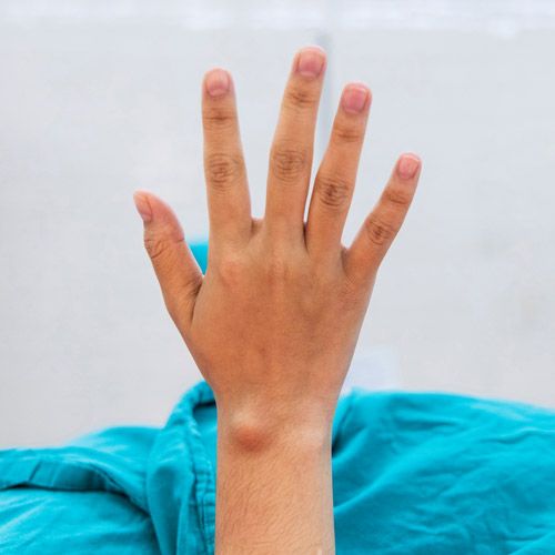 Ganglion Cyst