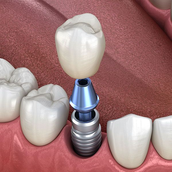 implant-supported crown