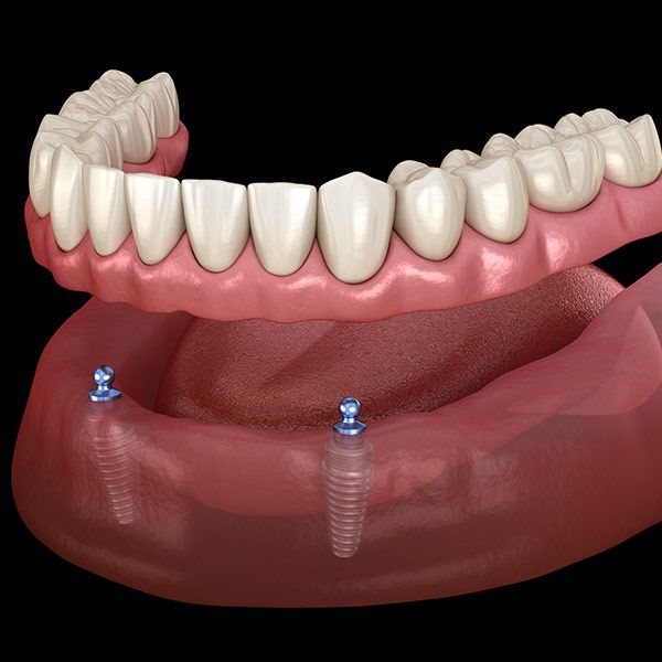 overdenture