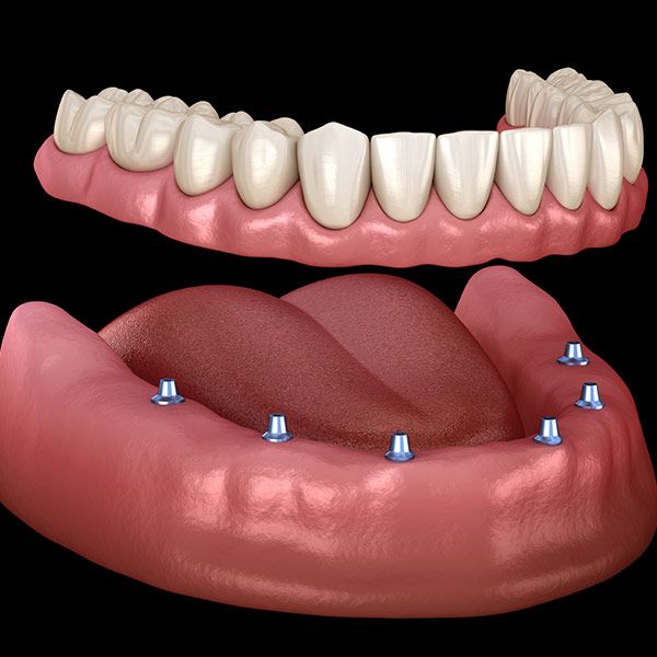 implant-supported denture