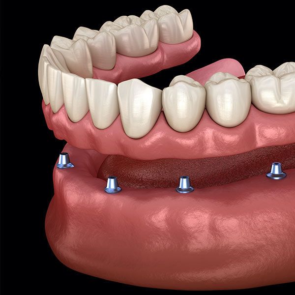 Implant-supported denture