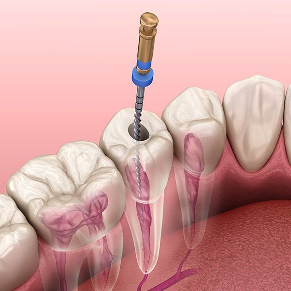 Illustration of root canal therapy