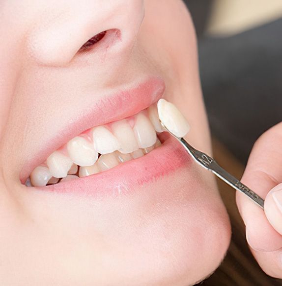 Shade-matching a veneer to a patient's smile