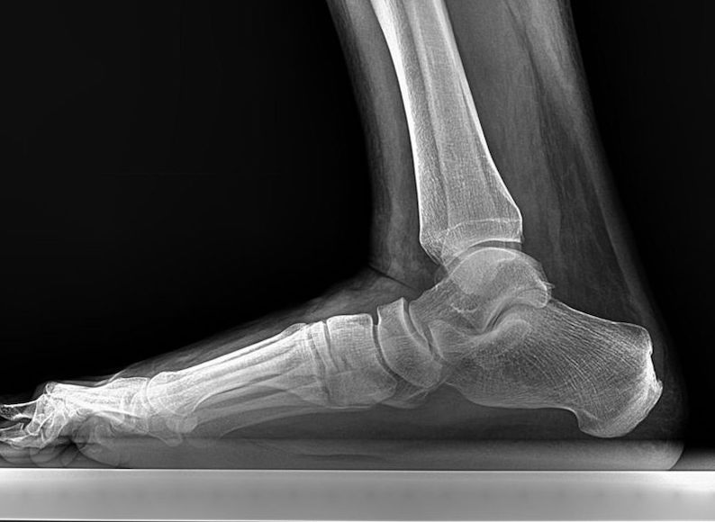 Flat foot with arch against floor
