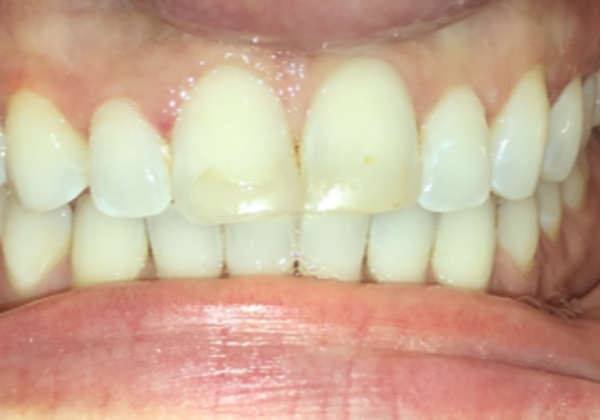 Stained, jagged smile.