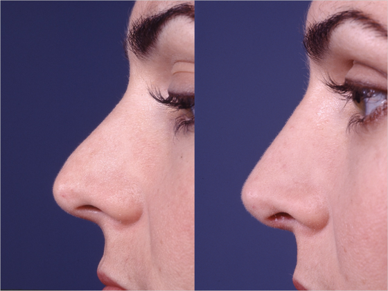 Female patient that underwent revision rhinoplasty