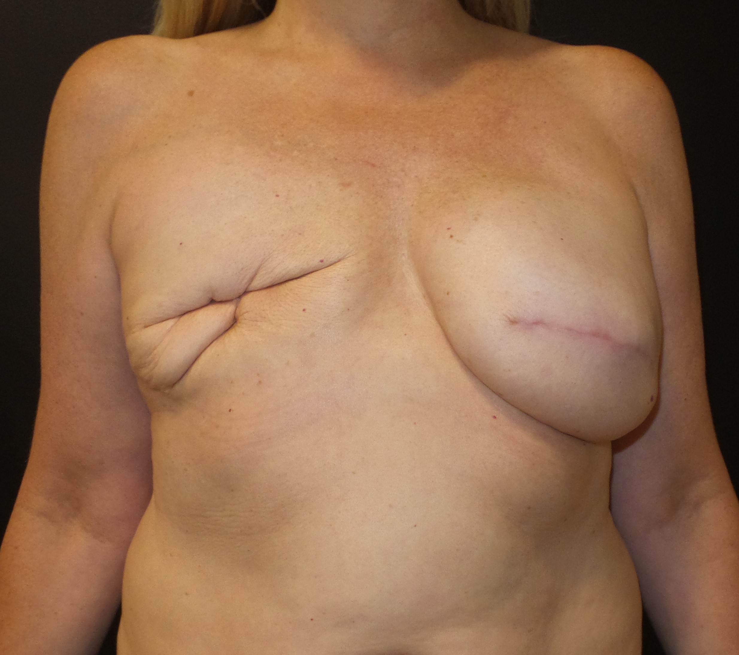 Breast tissue expander infection in breast reconstruction