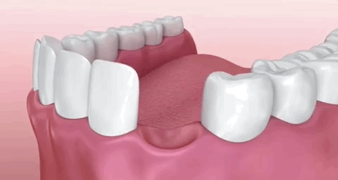 Dental Implant Animation