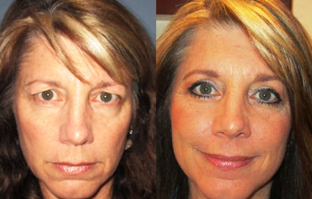 Kim Jensen Before and After