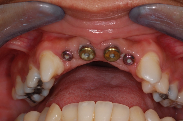before dental implant anterior reconstruction