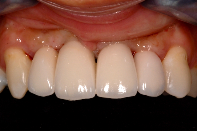 Nobel Biocare Envista ASC Crowns Maxillary Anterior