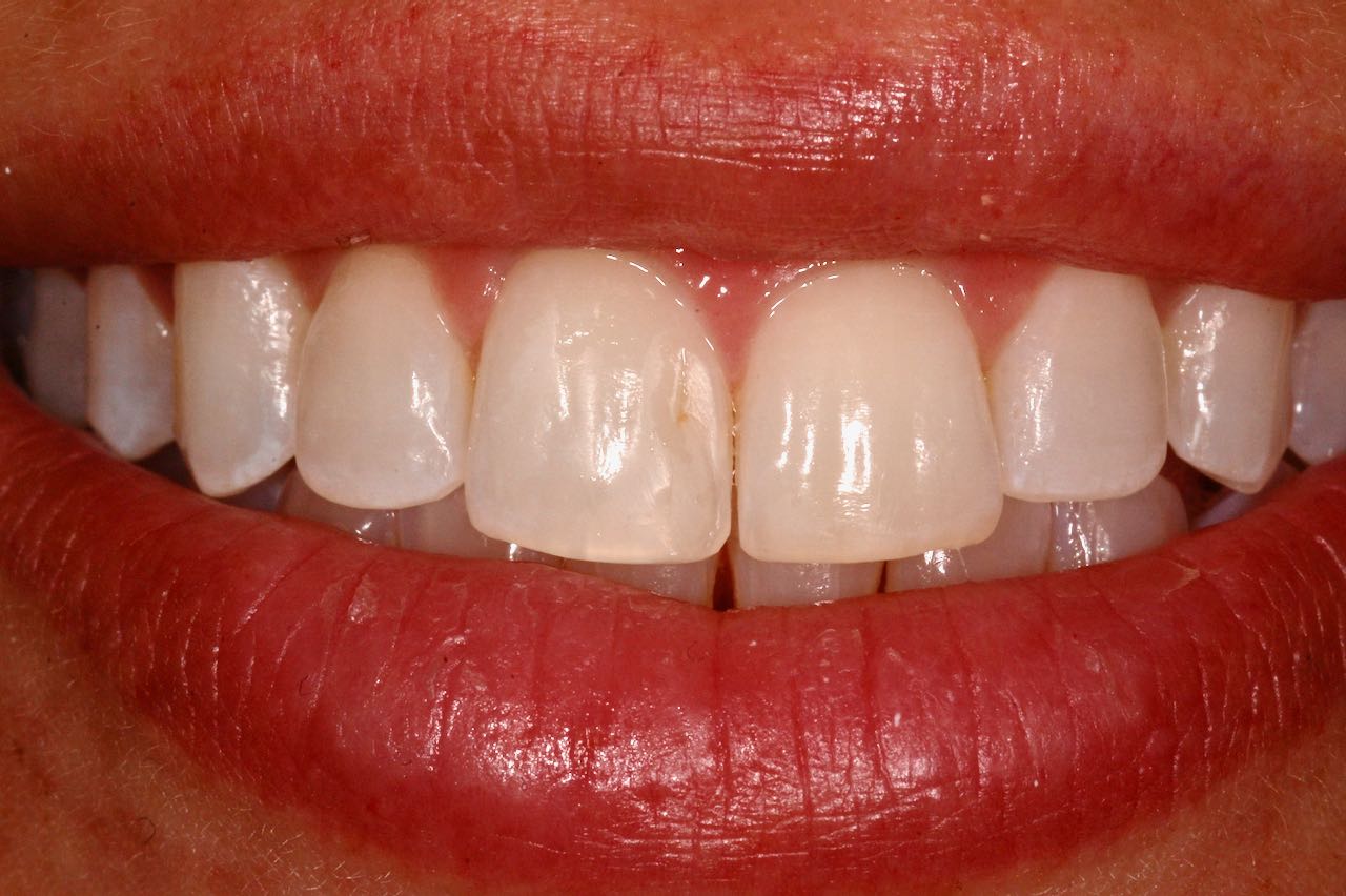 enameloplasty of incisors
