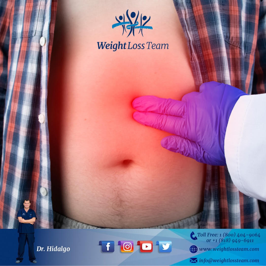 gastric sleeve revision