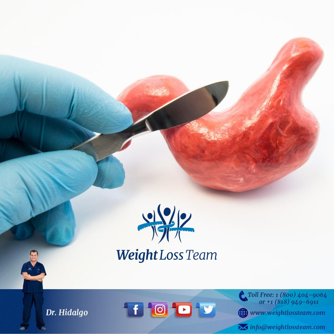 weight loss surgery in Mexico