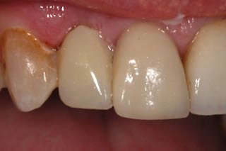 bonded composite implant temporary