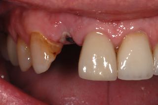 post op dental implant