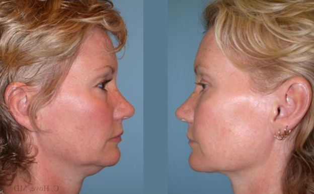 Neck Lift Before and After