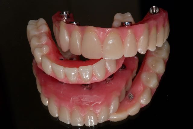 Acrylic over Authentic Nobel Procera Titanium Bar