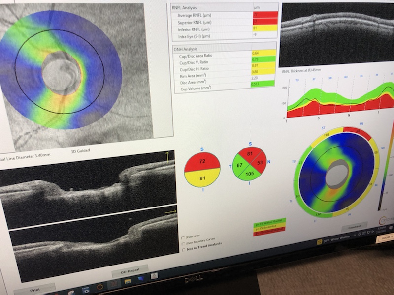 glaucoma-treatment-in-south-jordan-utah-people-really-can-go-blind
