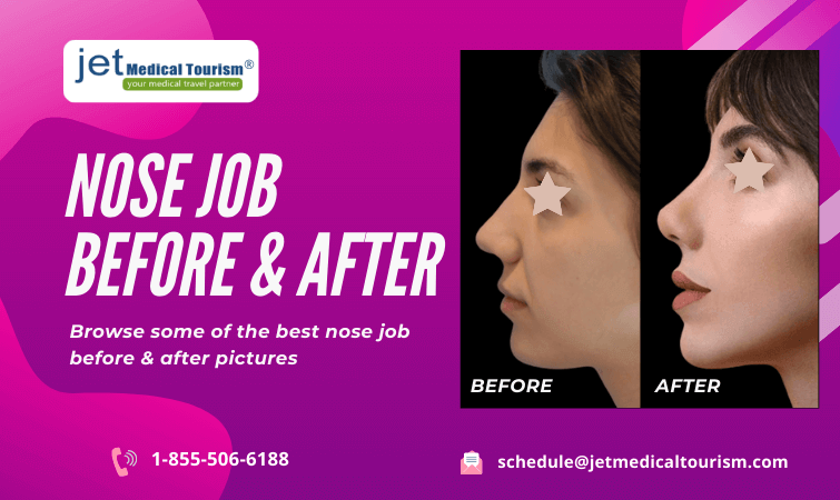 Nose Job Before and After - Jet Medical Tourism® in Mexico