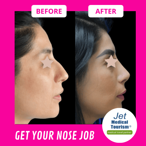 Nose Job Before and After - Jet Medical Tourism® in Mexico