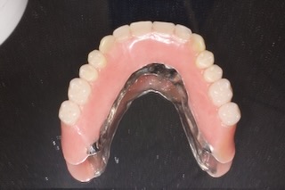 maxillary overdenture