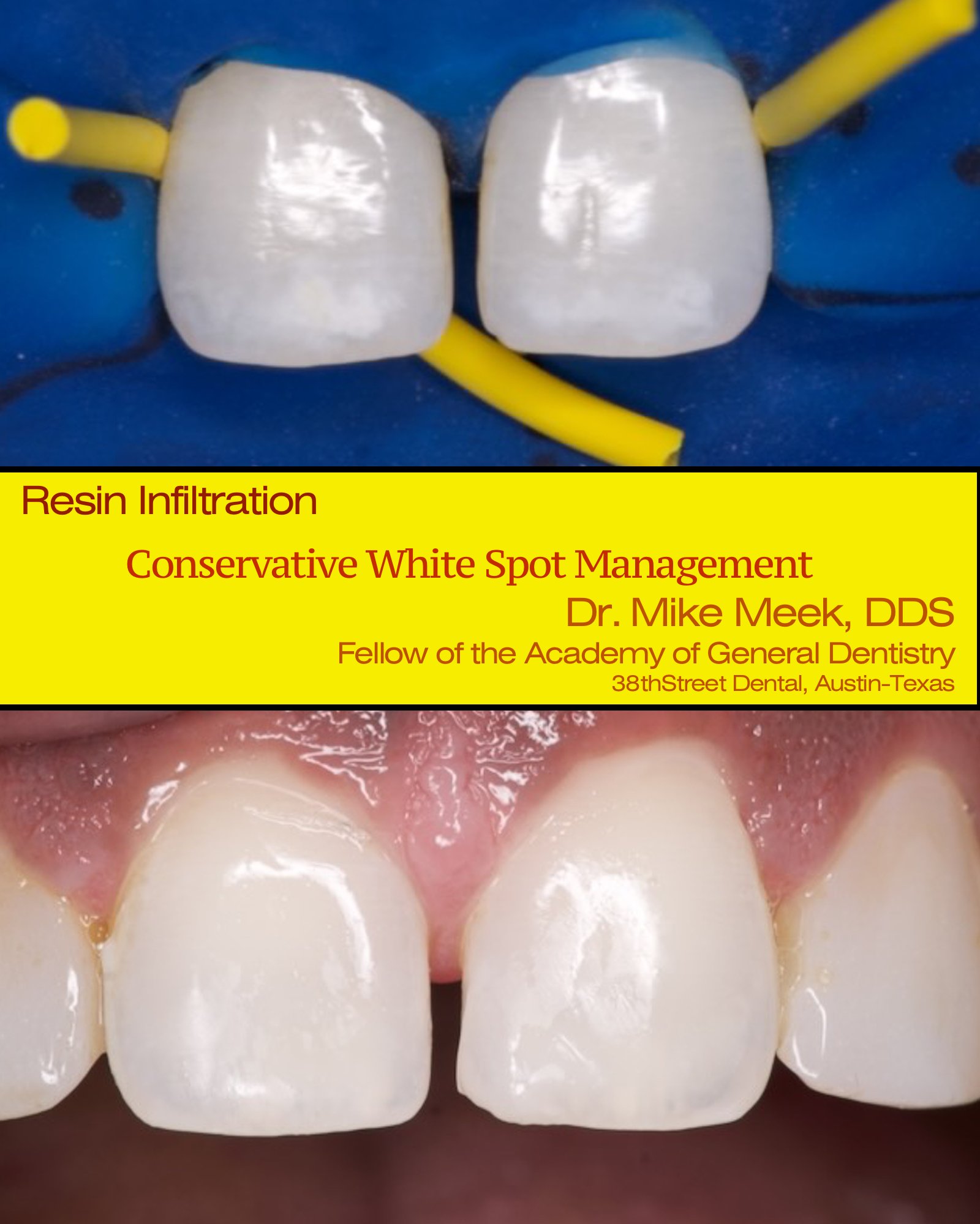 resin infiltration composite bonding