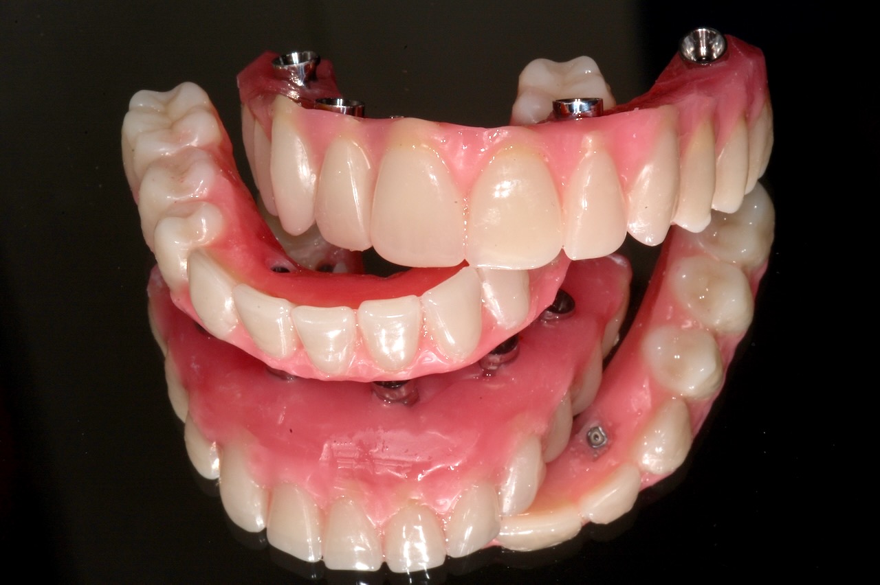 allon4, dental recall exam, dental implant Do I still have to go to...