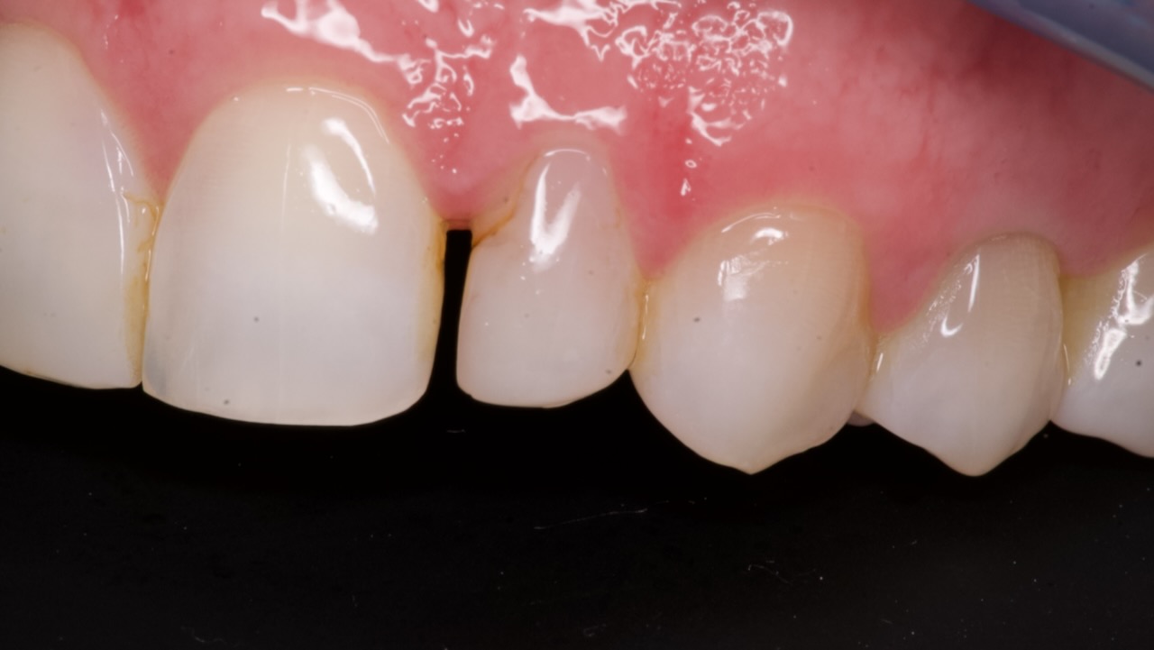 diastema
