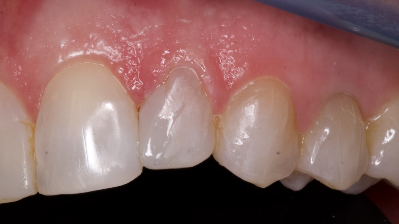 diastema closure using composite