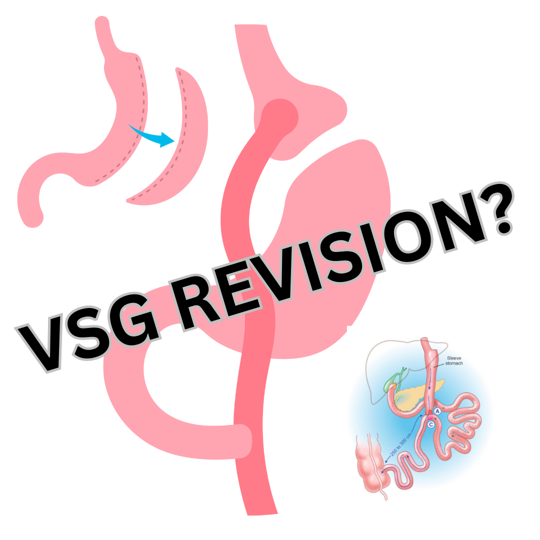 weight loss surgery revision