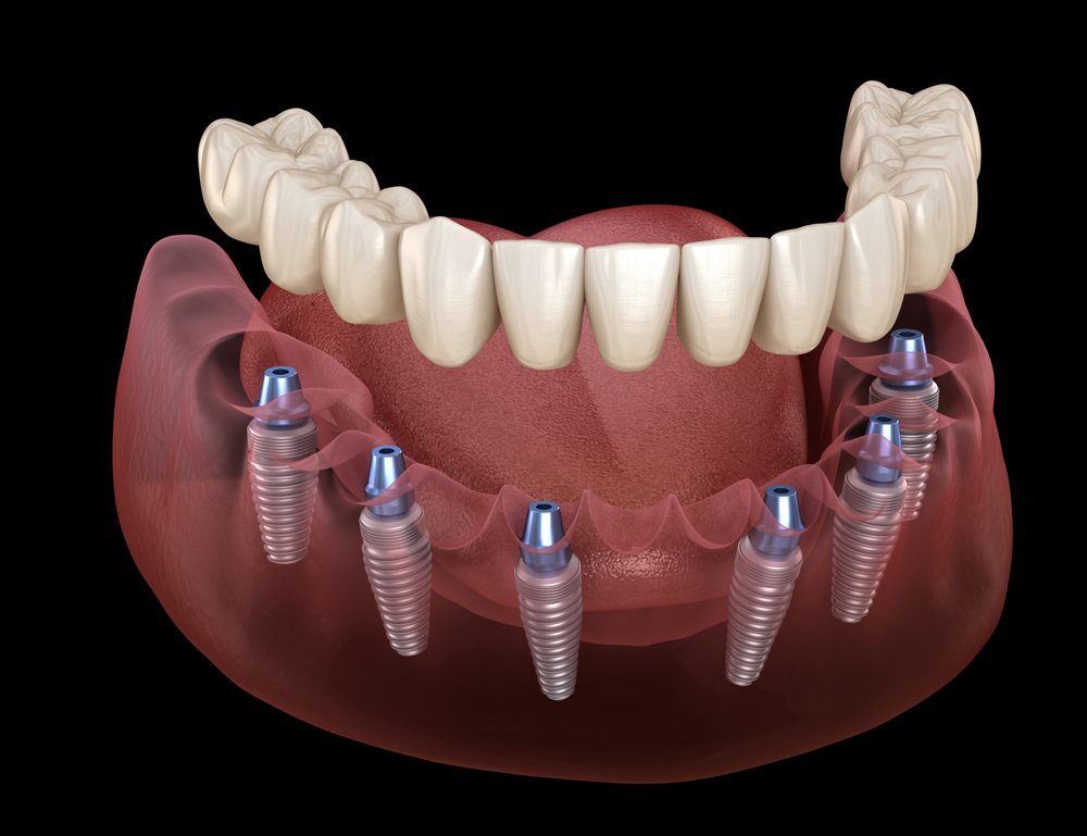 traditional dental implants and denture