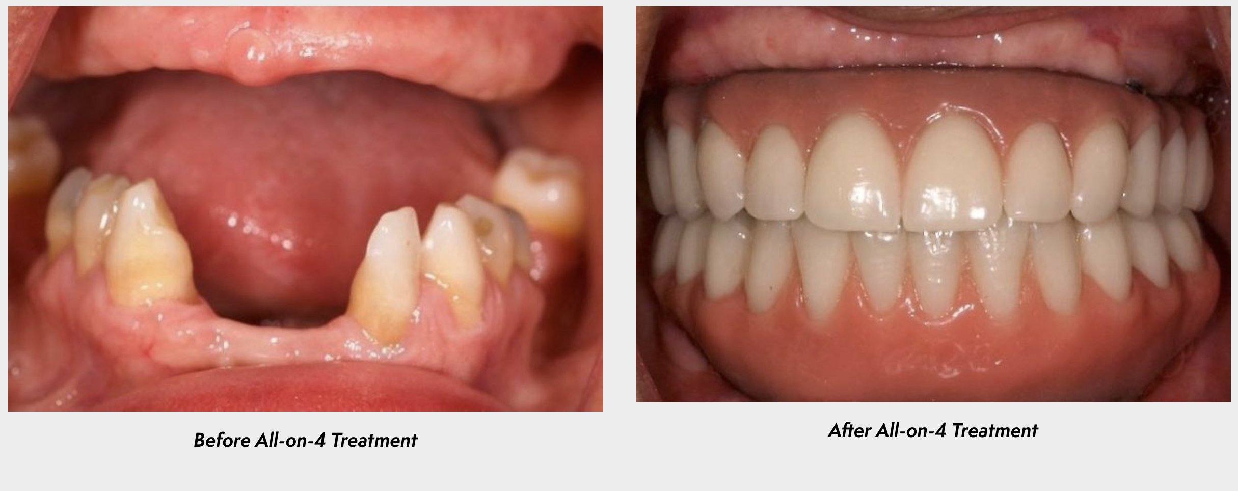 All-on-4 dental implants before and after photo