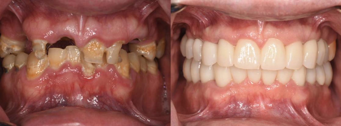 Patient before and after dental implants and full mouth reconstruction