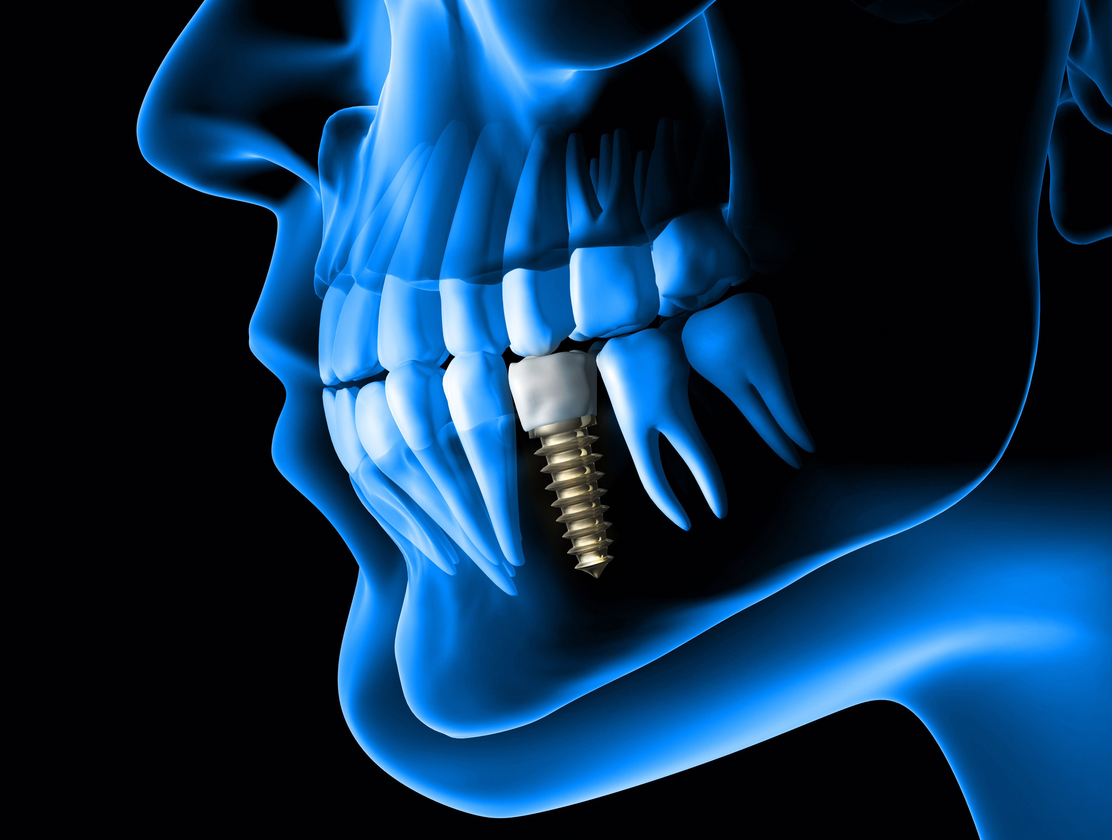 Digital rendering of implant in jaw