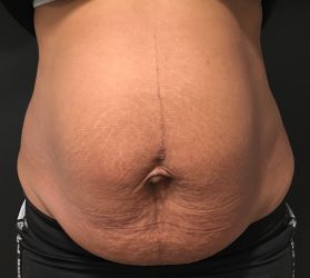 Abdominoplasty after Ozempic weight loss