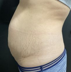 Emsculpt Abdomen Connecticut