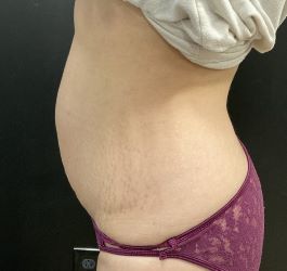 Emsculpt Abdomen Connecticut